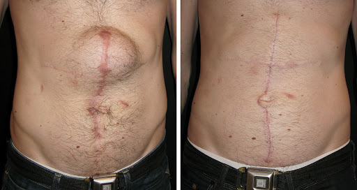Abdominal Hernia Surgery in Mumbai by dr. Vinay Jacob